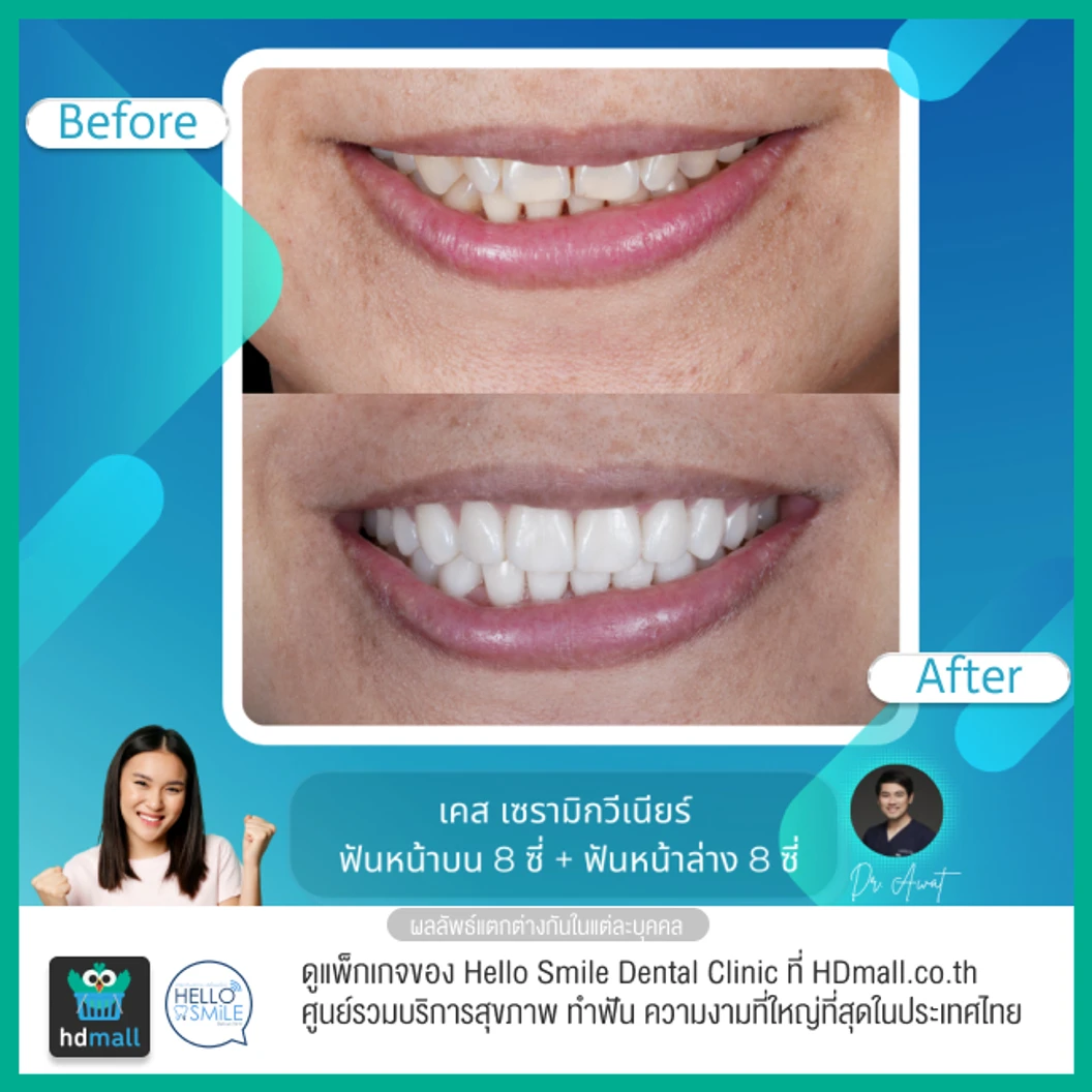 ทำวีเนียร์เซรามิกพอร์ซเลน สำหรับฟัน 16 ซี่