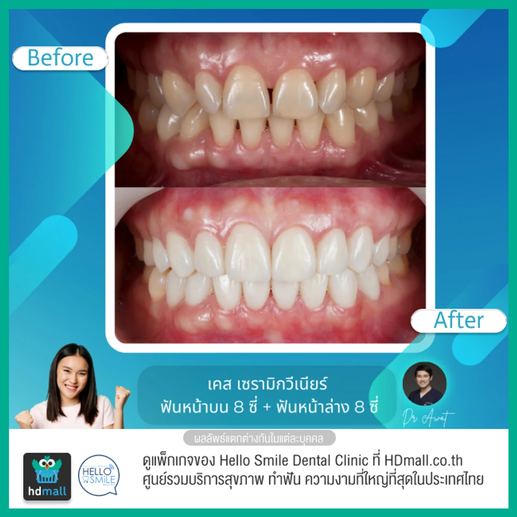 ทำวีเนียร์เซรามิกพอร์ซเลน สำหรับฟัน 16 ซี่