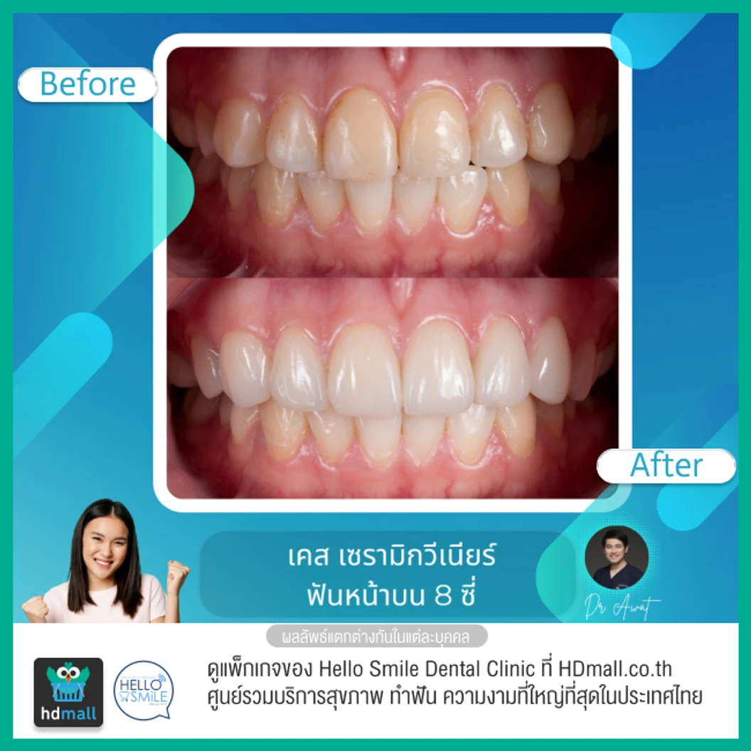 ทำวีเนียร์เซรามิกพอร์ซเลน สำหรับฟัน 8 ซี่