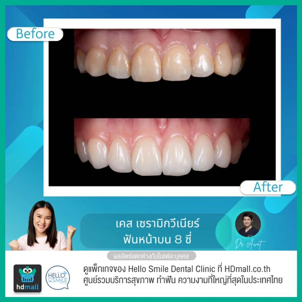 ทำวีเนียร์เซรามิกพอร์ซเลน สำหรับฟัน 8 ซี่