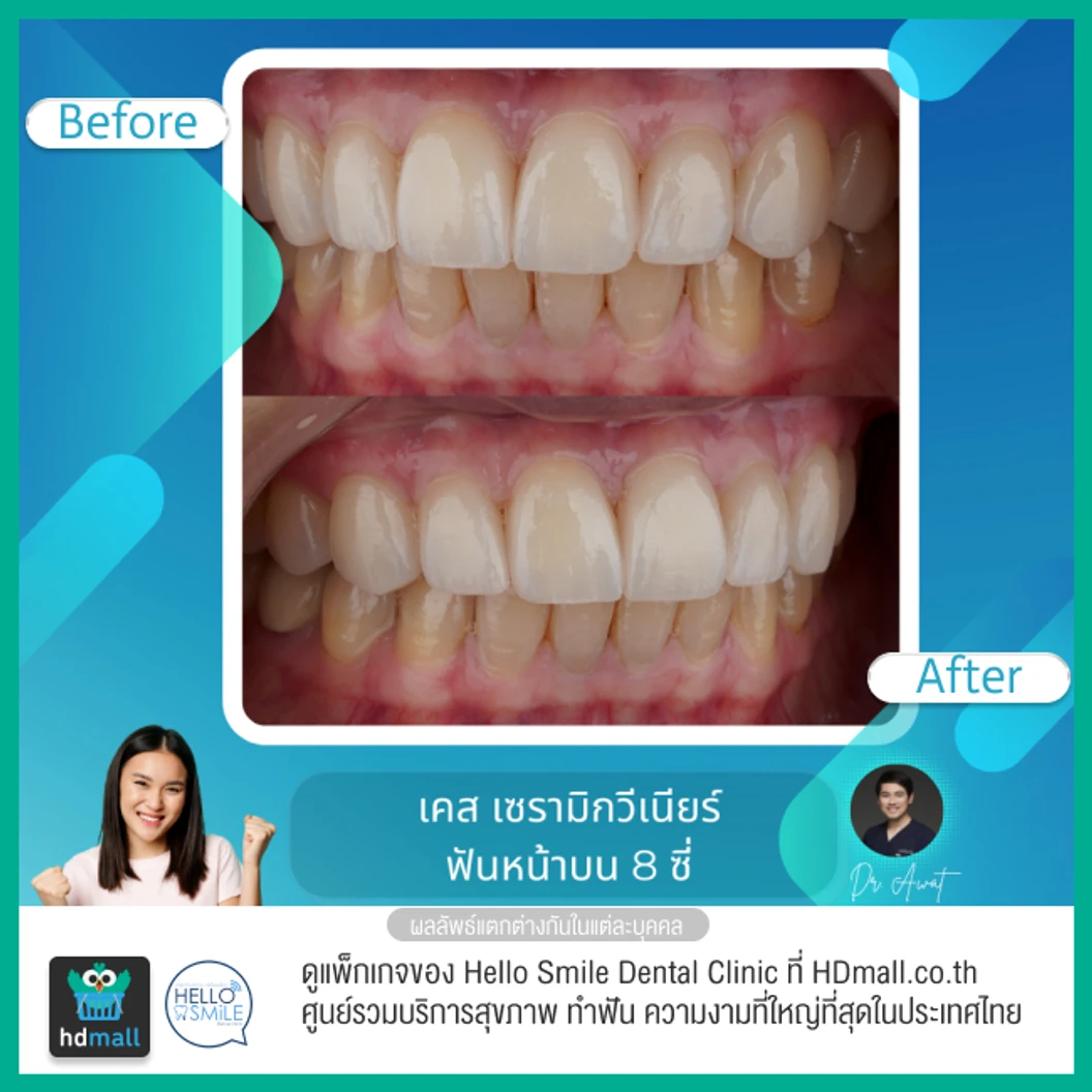 ทำวีเนียร์เซรามิกพอร์ซเลน สำหรับฟัน 8 ซี่