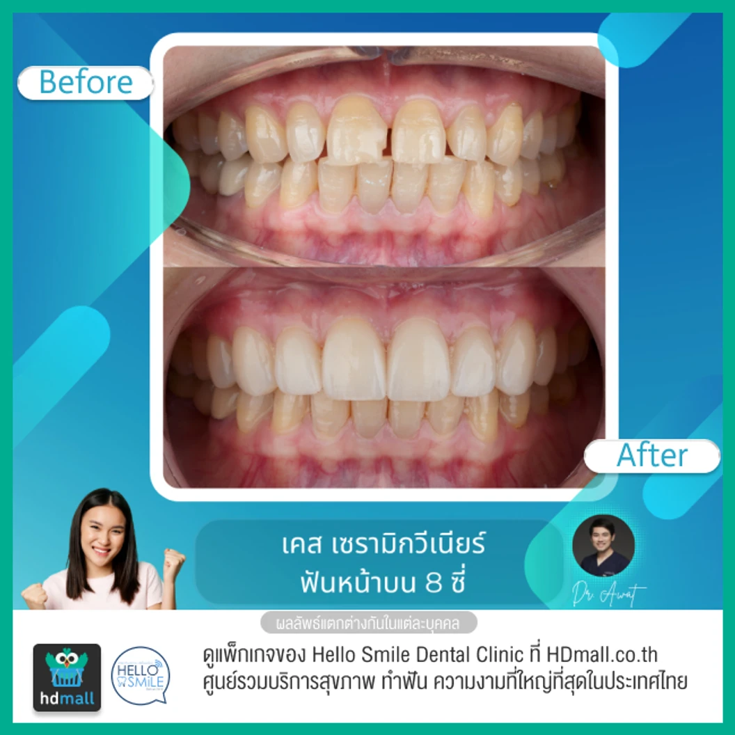 ทำวีเนียร์เซรามิกพอร์ซเลน สำหรับฟัน 8 ซี่