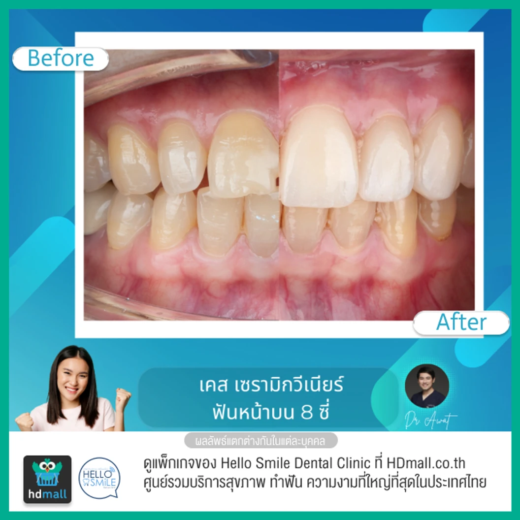 ทำวีเนียร์เซรามิกพอร์ซเลน สำหรับฟัน 8 ซี่