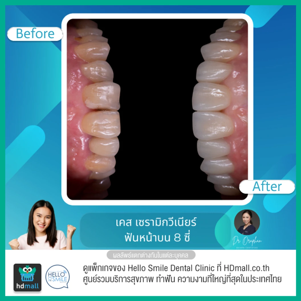 ทำวีเนียร์เซรามิกพอร์ซเลน สำหรับฟัน 8 ซี่