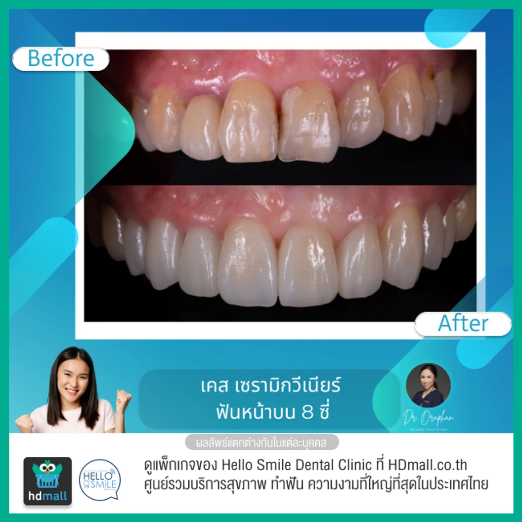 ทำวีเนียร์เซรามิกพอร์ซเลน สำหรับฟัน 8 ซี่