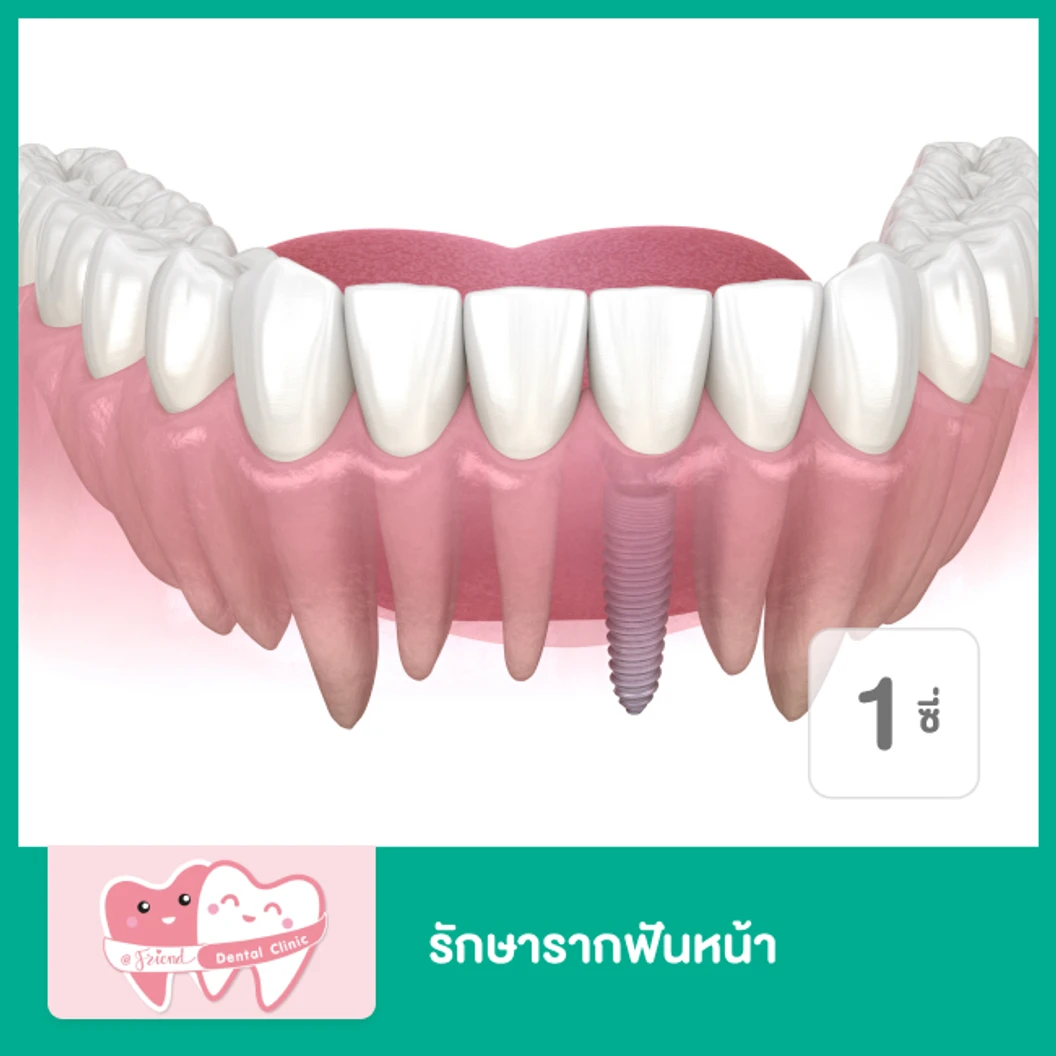 รักษารากฟันหน้า 1 ซี่