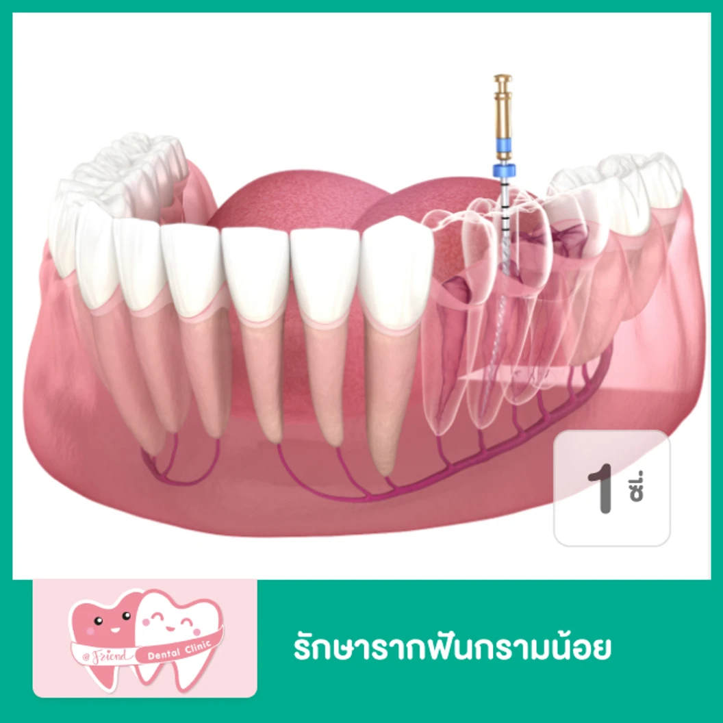 รักษารากฟันกรามน้อย 1 ซี่