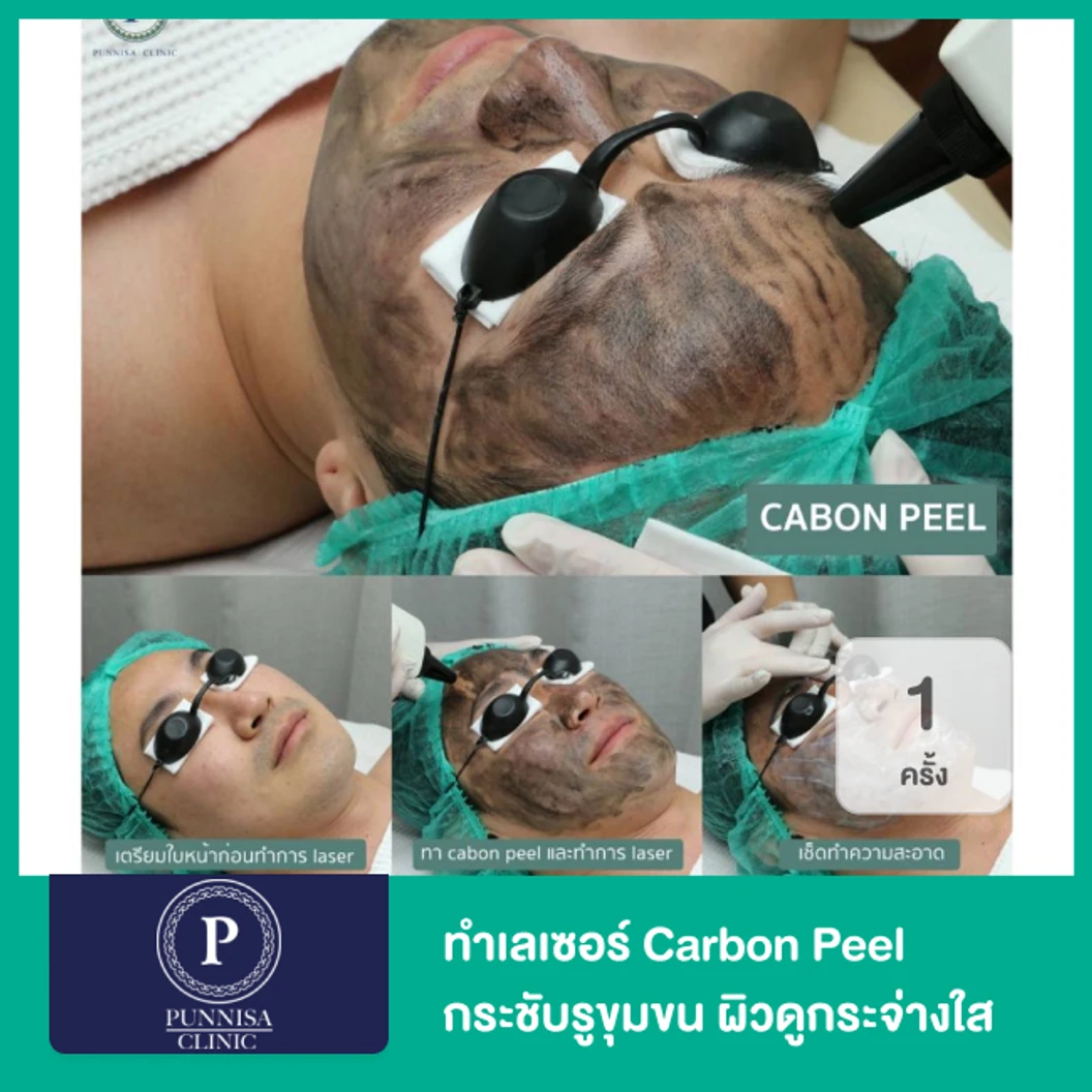 ทำเลเซอร์ Carbon Peel กระชับรูขุมขน ผิวดูกระจ่างใส 1 ครั้ง
