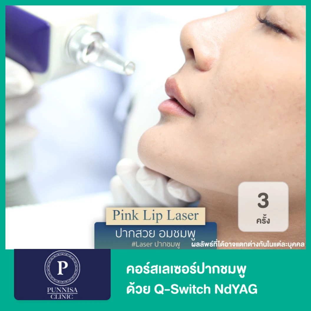 เลเซอร์ปากชมพู ด้วย Q-switch Nd:YAG 3 ครั้ง