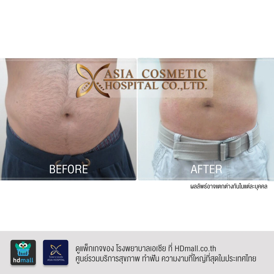 ดูดไขมันหน้าท้องและเอว 1 ครั้ง