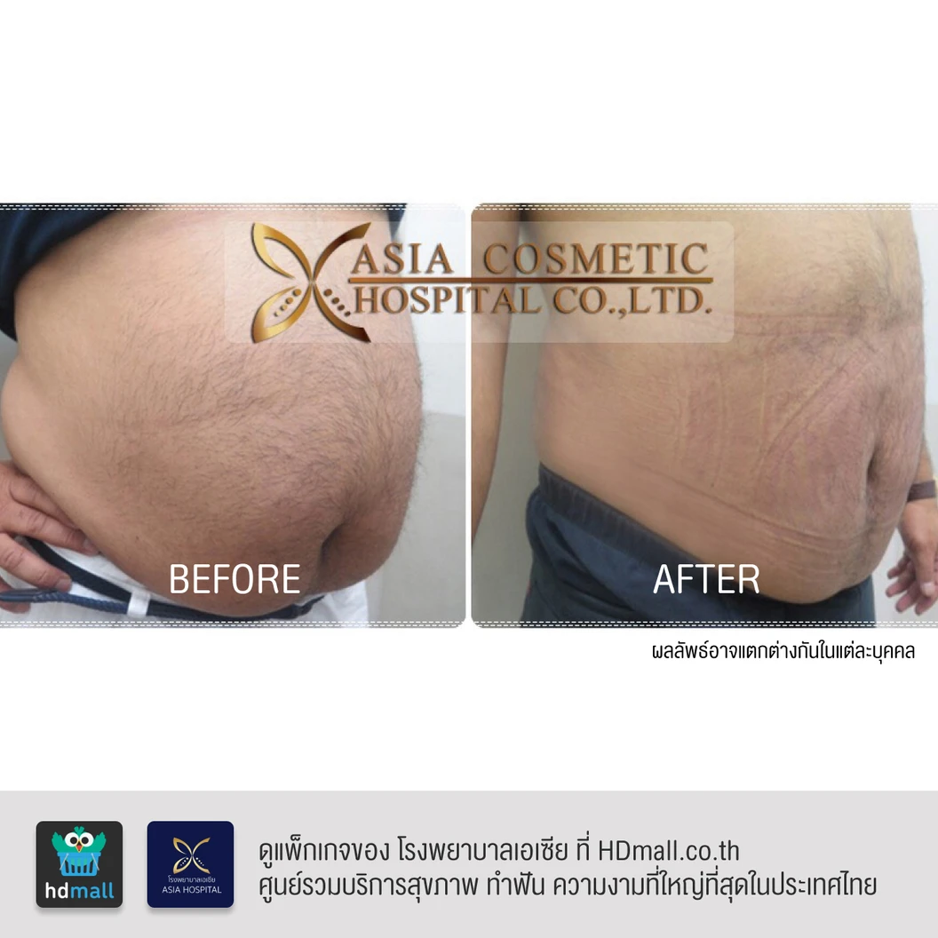 ดูดไขมันหน้าท้องและเอว 1 ครั้ง