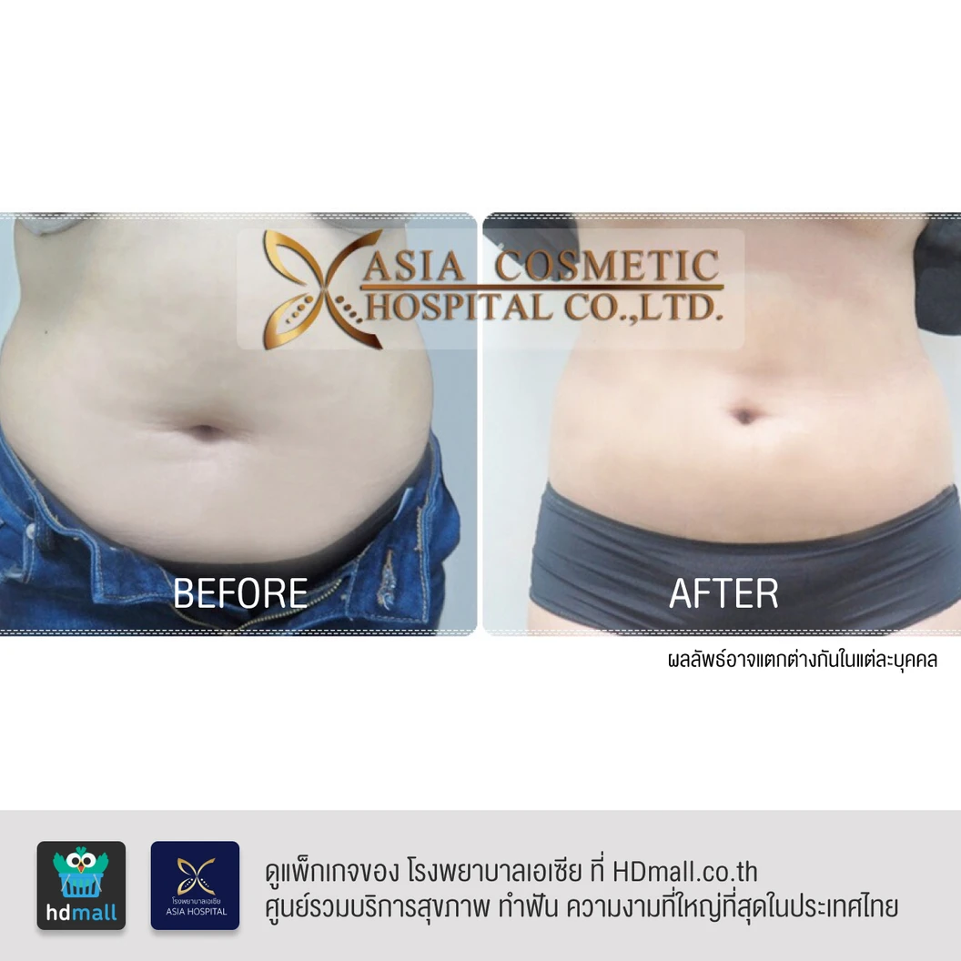 ดูดไขมันหน้าท้องและเอว 1 ครั้ง