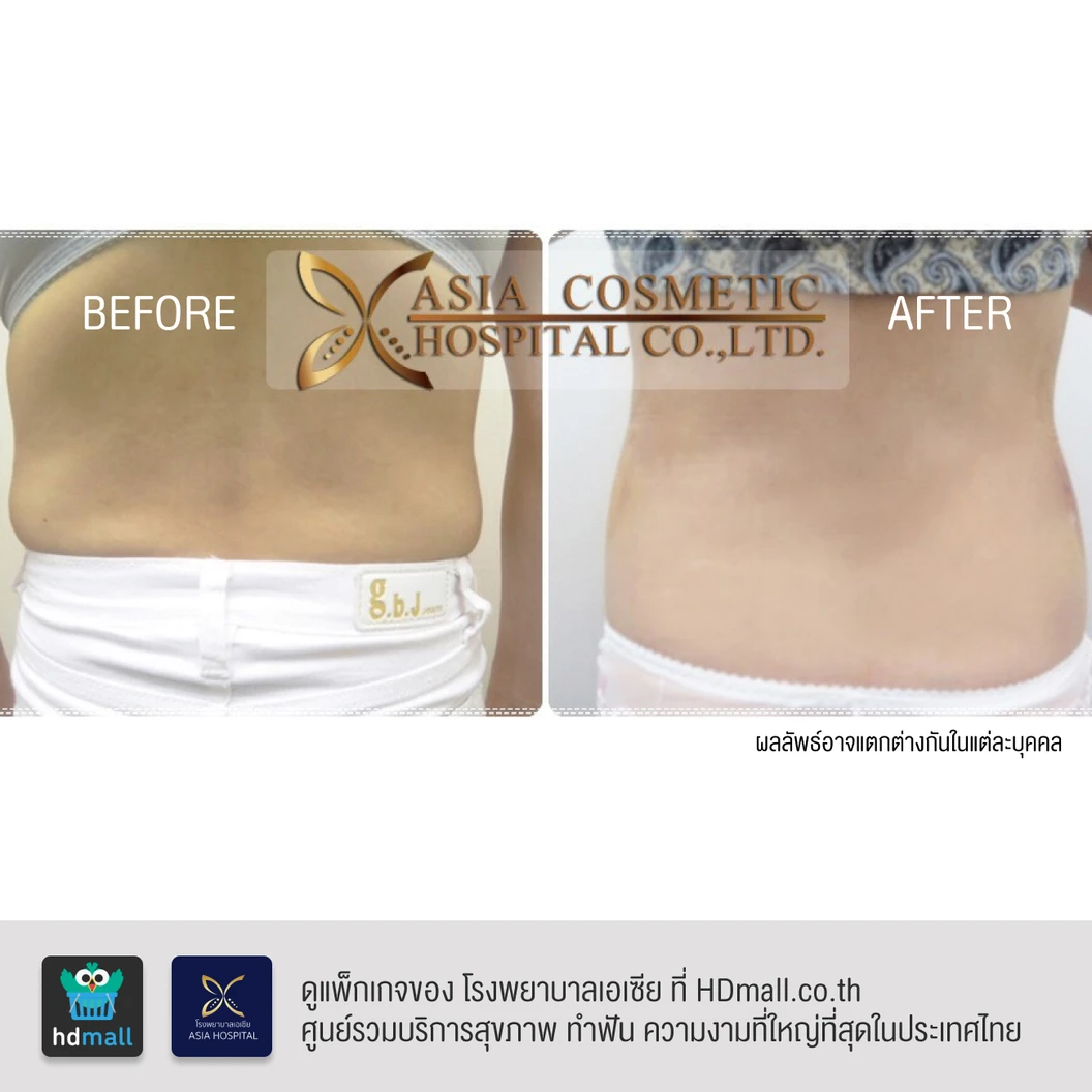 ดูดไขมันหน้าท้องและเอว 1 ครั้ง