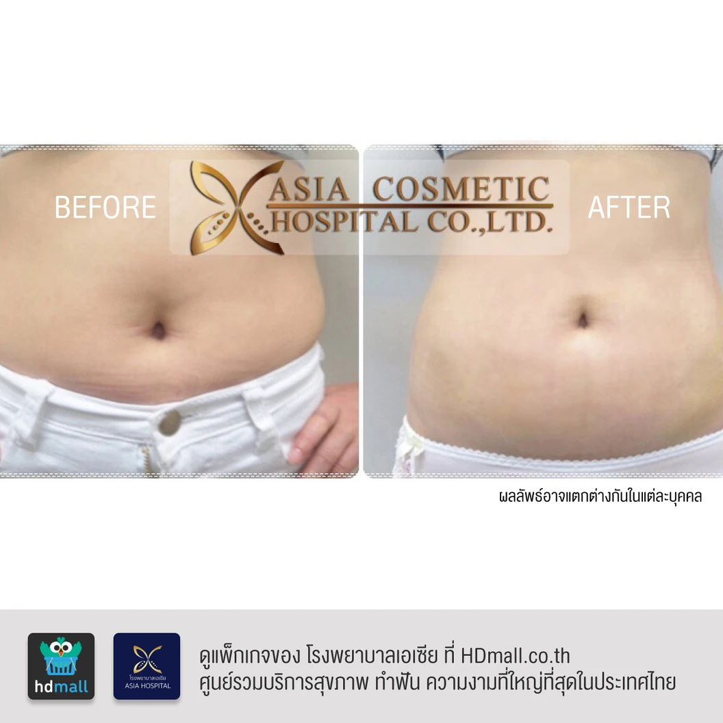 ดูดไขมันหน้าท้องและเอว 1 ครั้ง