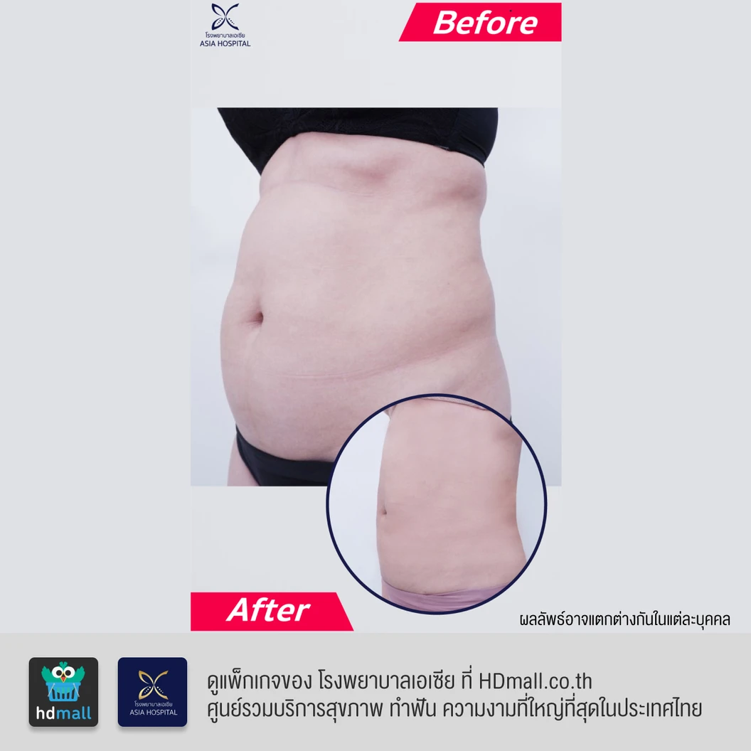 ดูดไขมันหน้าท้องและเอว 1 ครั้ง