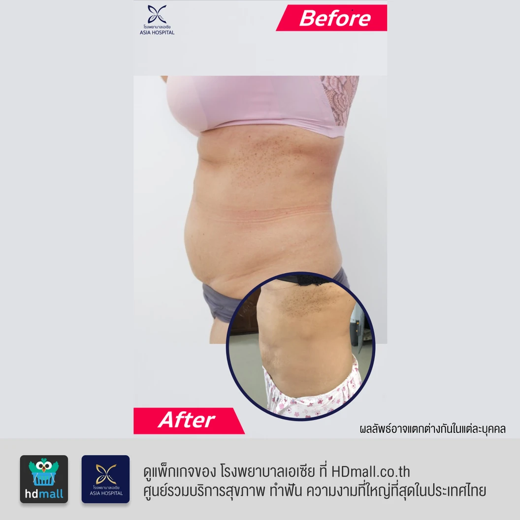 ดูดไขมันหน้าท้องและเอว 1 ครั้ง