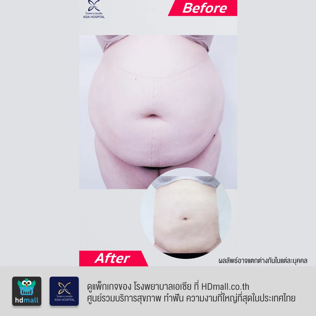 ดูดไขมันหน้าท้องและเอว 1 ครั้ง