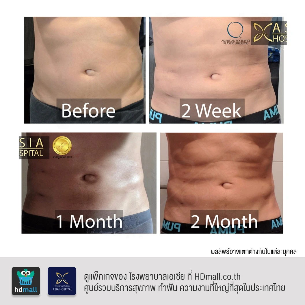 ดูดไขมันหน้าท้องและเอว 1 ครั้ง