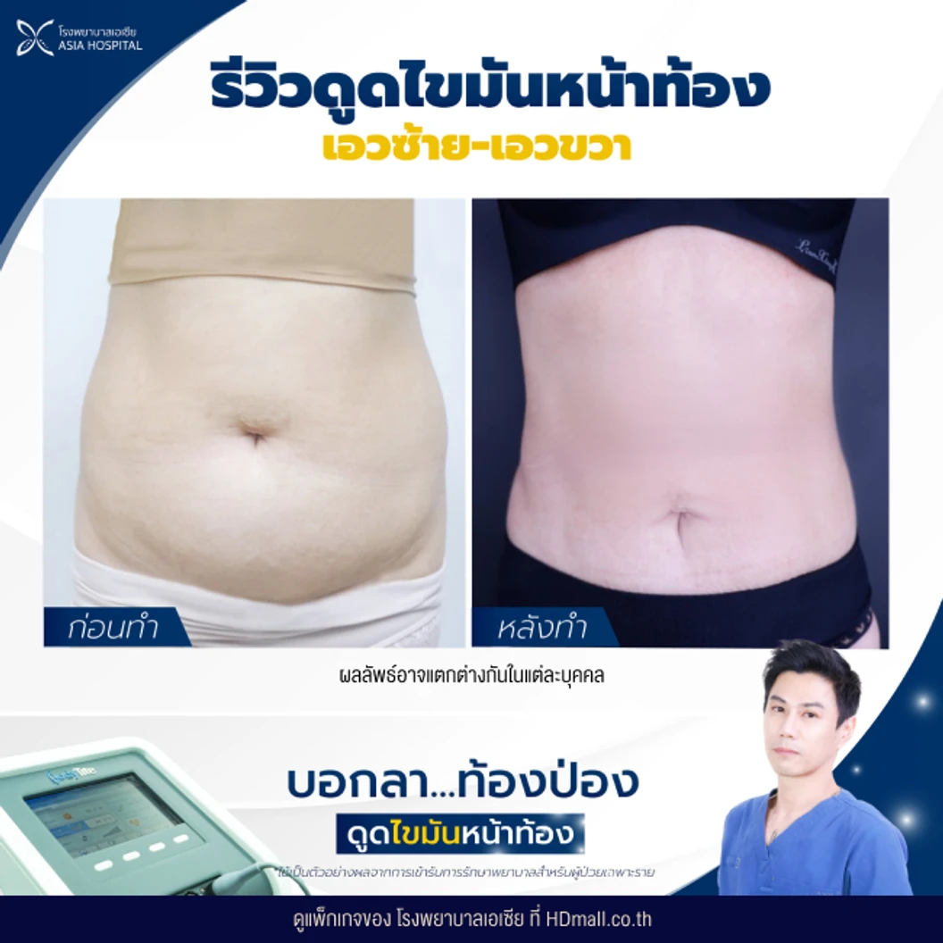 ดูดไขมันหน้าท้องและเอว 1 ครั้ง