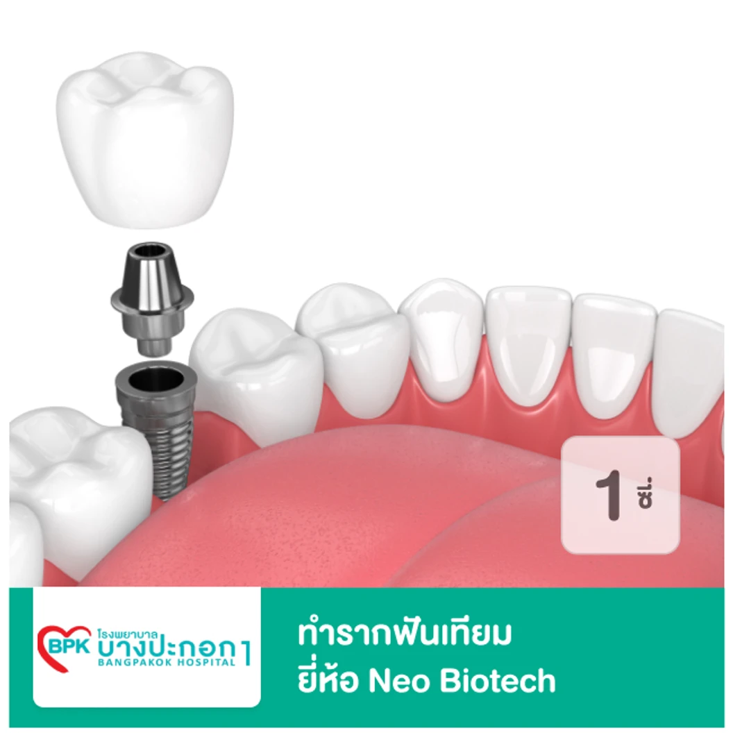ทำรากฟันเทียม ยี่ห้อ Neo Biotech สำหรับฟัน 1 ซี่