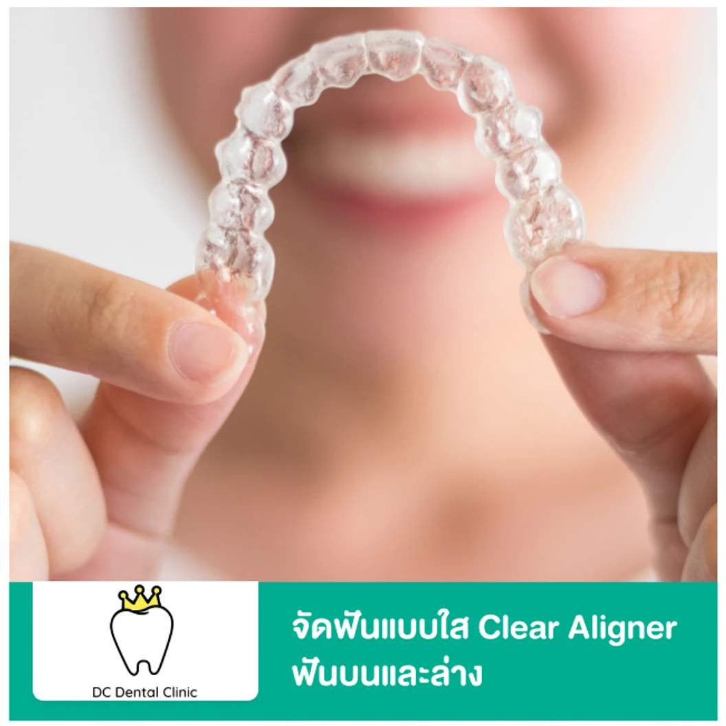 จัดฟันแบบใส Clear Aligner ฟันบนและล่าง