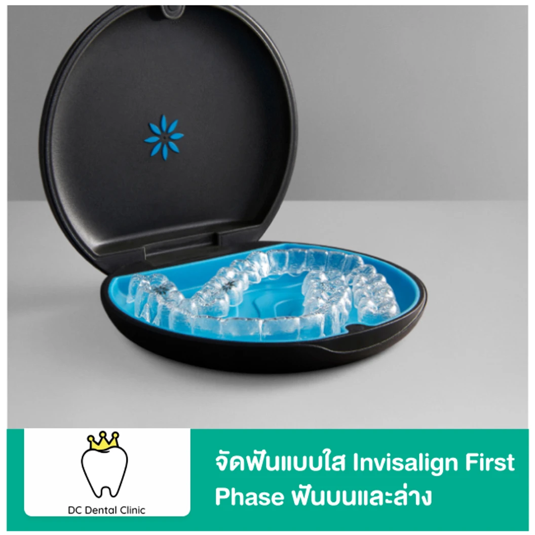 จัดฟันแบบใส Invisalign First Phase ฟันบนและล่าง
