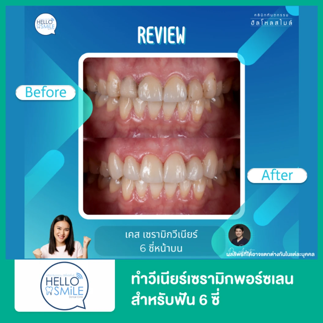 ทำวีเนียร์เซรามิกพอร์ซเลน สำหรับฟัน 6 ซี่