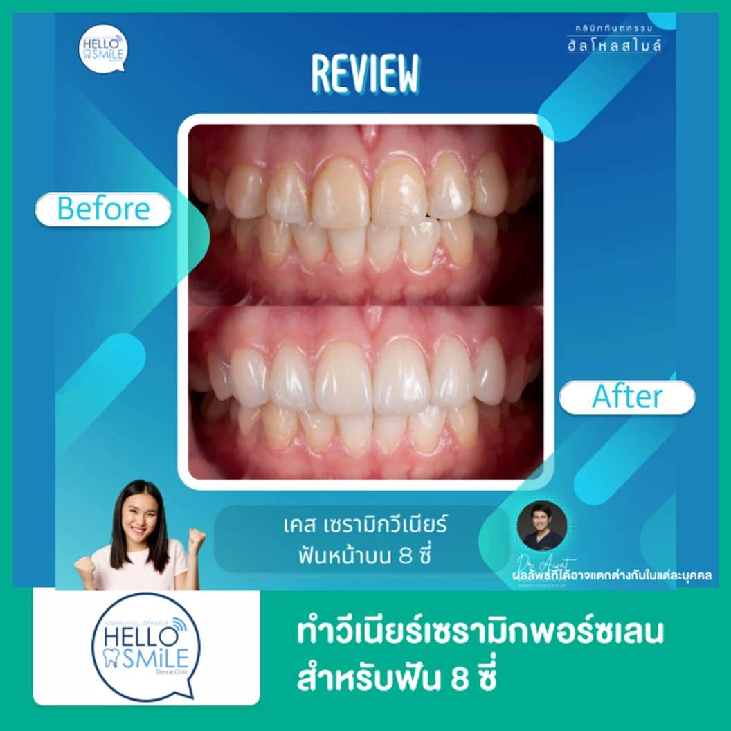 ทำวีเนียร์เซรามิกพอร์ซเลน สำหรับฟัน 8 ซี่