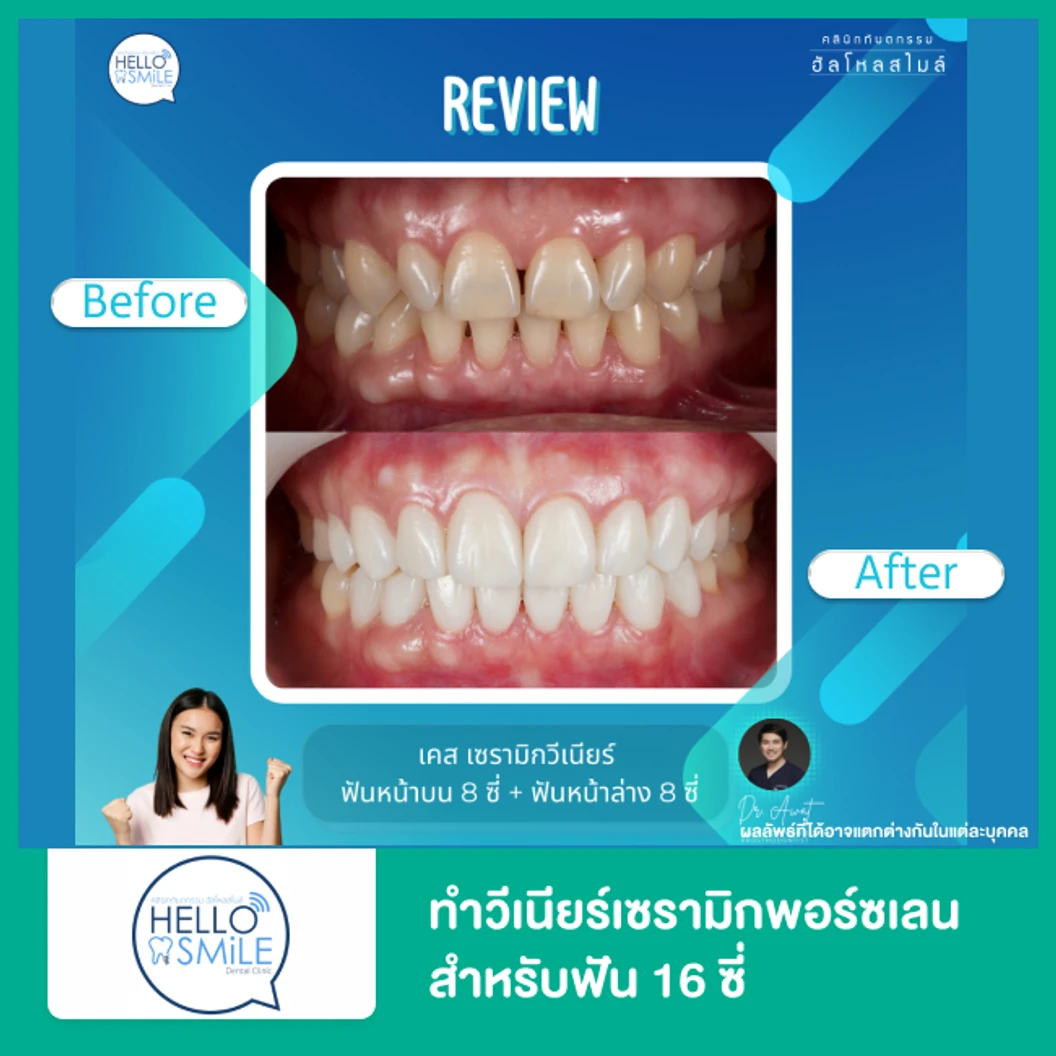 ทำวีเนียร์เซรามิกพอร์ซเลน สำหรับฟัน 16 ซี่