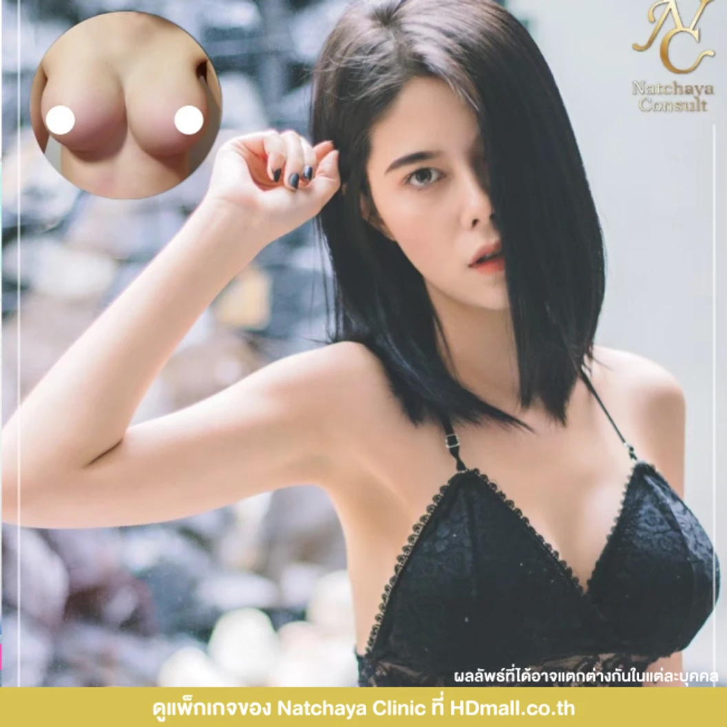 เสริมหน้าอก เทคนิควางซิลิโคนใต้กล้ามเนื้อ ด้วยซิลิโคน Mentor อเมริกา เพิ่มความมั่นใจในขนาดหน้าอก
