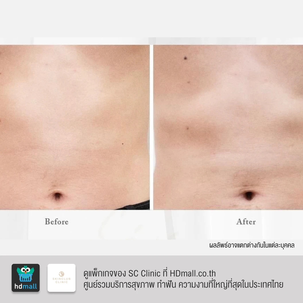 สร้างกล้ามเนื้อ สลายไขมัน ด้วย HIFEM บริเวณหน้าท้อง 1 ครั้ง