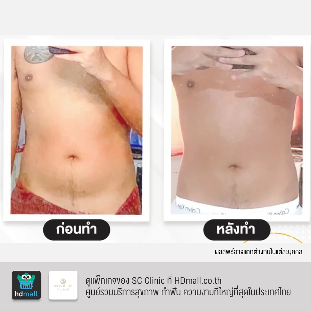 สร้างกล้ามเนื้อ สลายไขมัน ด้วย HIFEM บริเวณหน้าท้อง 1 ครั้ง