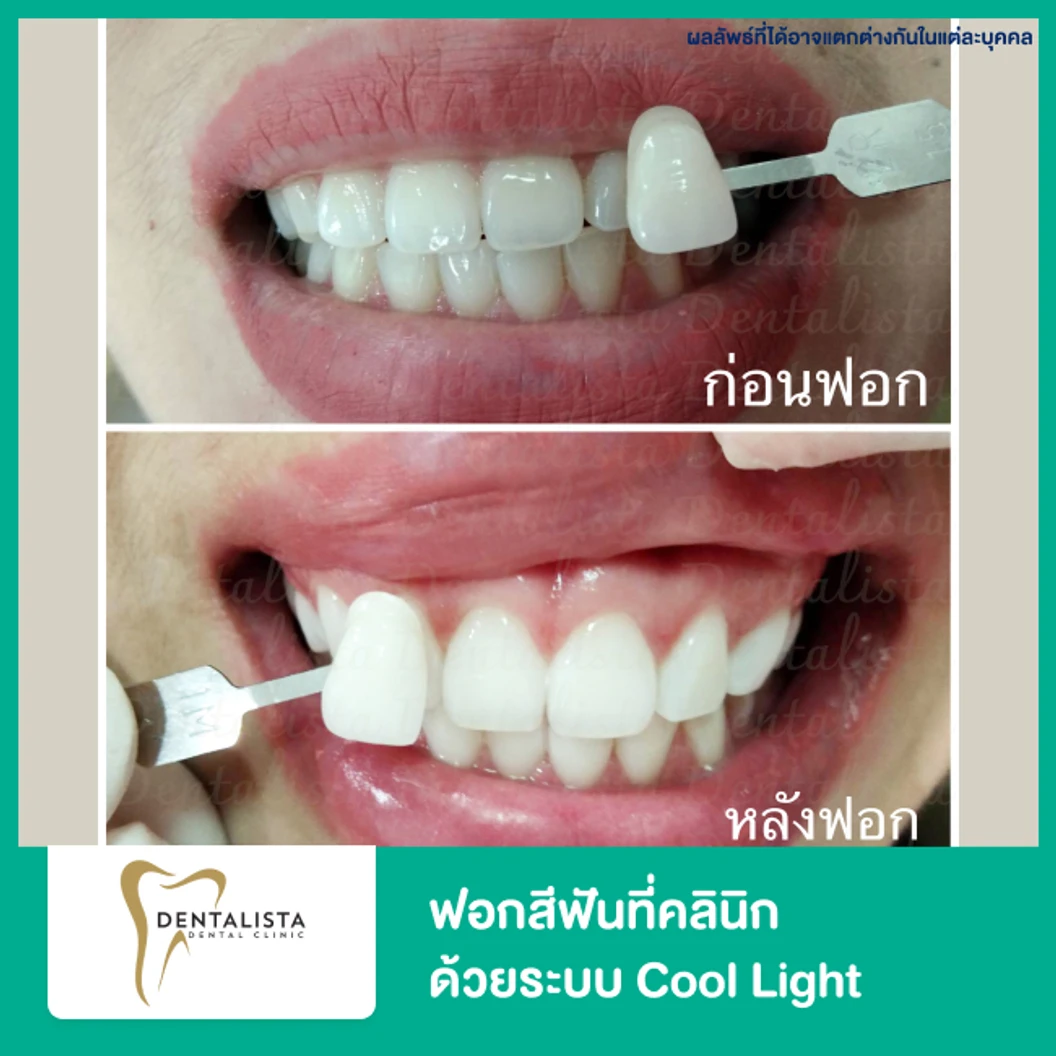 ฟอกสีฟันที่คลินิก ด้วยระบบ Cool Light