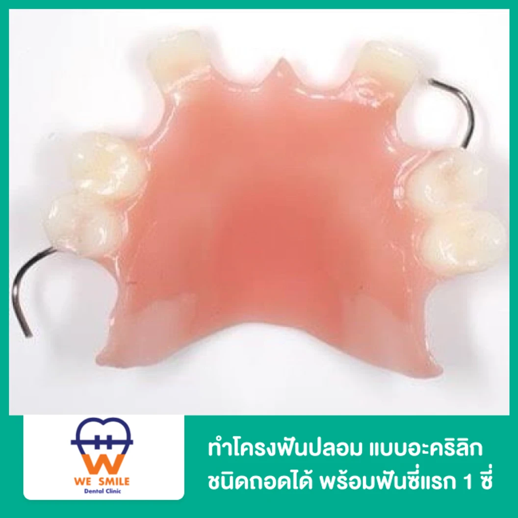 ทำโครงฟันปลอม แบบอะคริลิก ชนิดถอดได้ พร้อมฟันซี่แรก 1 ซี่
