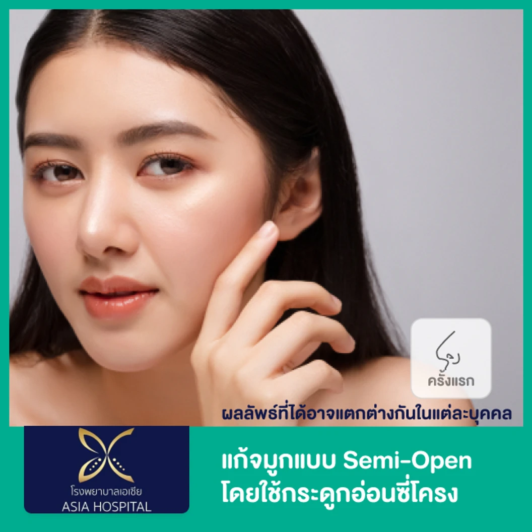 แก้จมูกแบบ Semi-Open โดยใช้กระดูกอ่อนซี่โครง