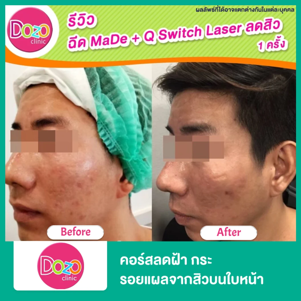 คอร์สลดฝ้า กระ รอยแผลจากสิวบนใบหน้า ด้วยเลเซอร์ Q-Switch ไม่จำกัดช็อต ขึ้นอยู่กับแพทย์ประเมิน + มาส์กหน้า เพิ่มความกระจ่างใส 3 ครั้ง