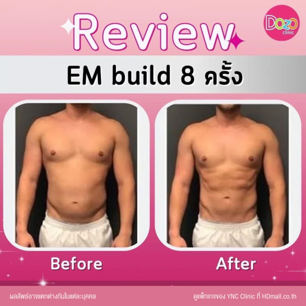 กระชับสัดส่วนสร้างกล้ามเนื้อ ด้วยเครื่อง EM Build เลือก 1 บริเวณ หน้าท้อง ก้น แขน หรือขา 1 ครั้ง