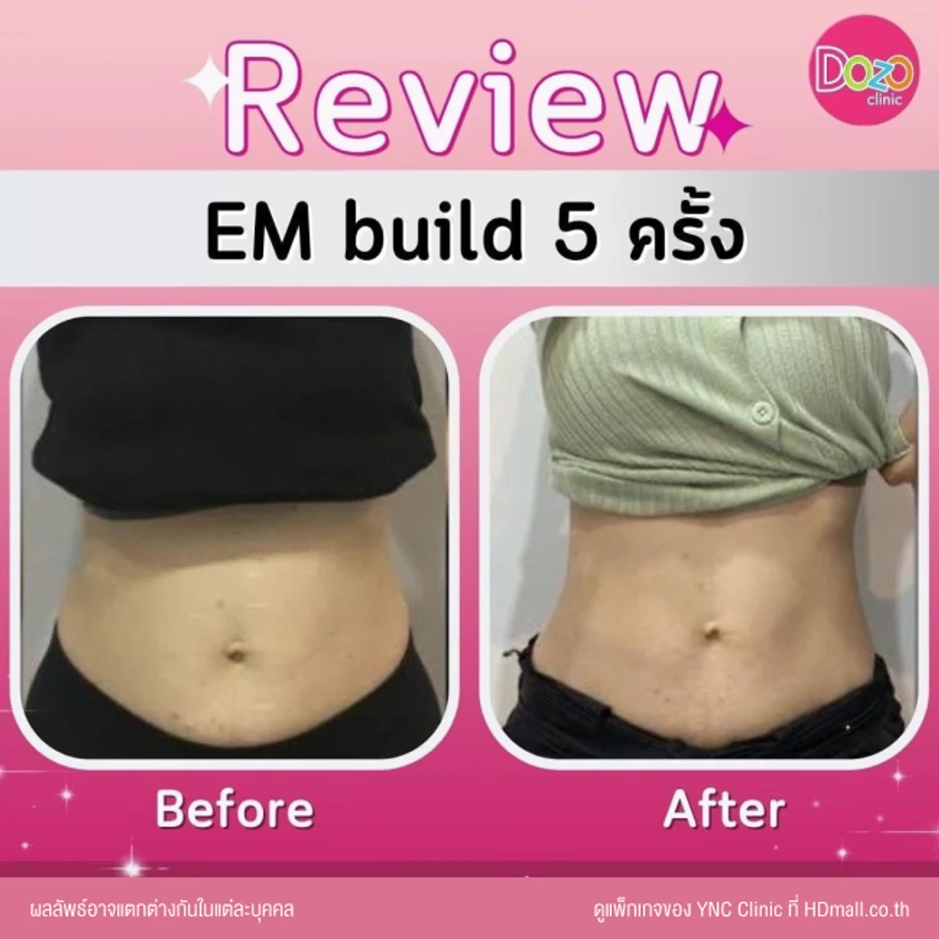 กระชับสัดส่วนสร้างกล้ามเนื้อ ด้วยเครื่อง EM Build เลือก 1 บริเวณ หน้าท้อง ก้น แขน หรือขา 1 ครั้ง