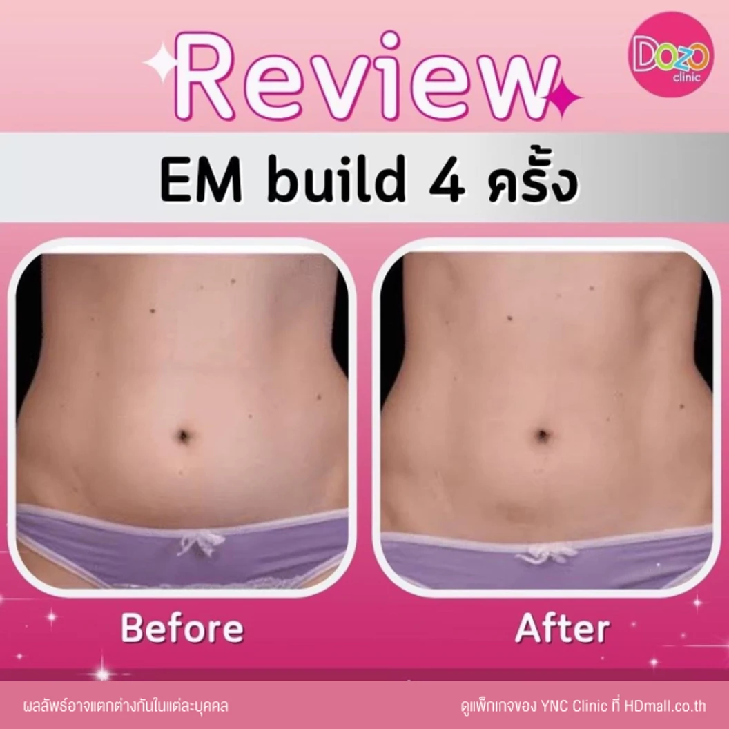 กระชับสัดส่วนสร้างกล้ามเนื้อ ด้วยเครื่อง EM Build เลือก 1 บริเวณ หน้าท้อง ก้น แขน หรือขา 1 ครั้ง