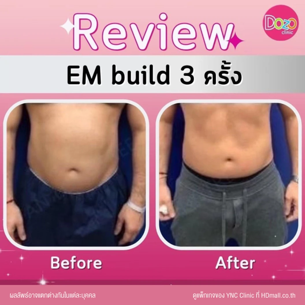 กระชับสัดส่วนสร้างกล้ามเนื้อ ด้วยเครื่อง EM Build เลือก 1 บริเวณ หน้าท้อง ก้น แขน หรือขา 1 ครั้ง