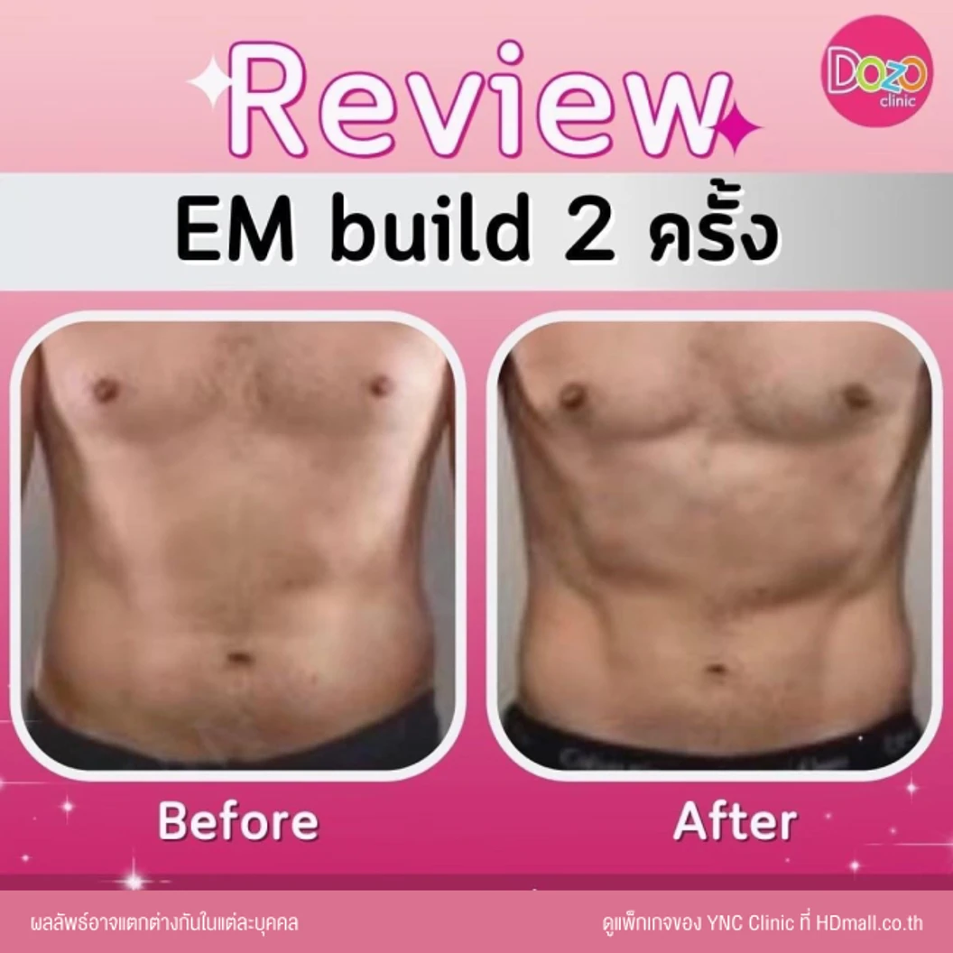 กระชับสัดส่วนสร้างกล้ามเนื้อ ด้วยเครื่อง EM Build เลือก 1 บริเวณ หน้าท้อง ก้น แขน หรือขา 1 ครั้ง