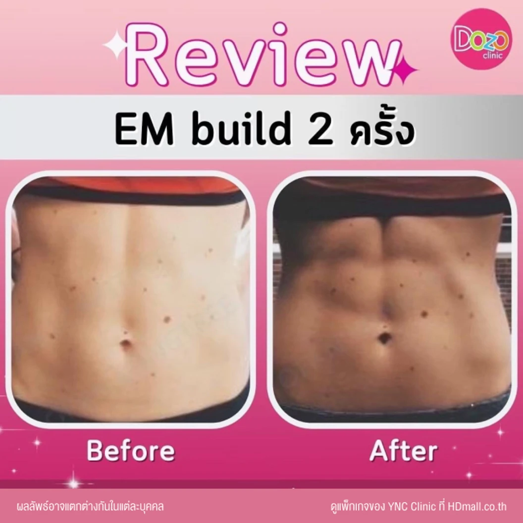 กระชับสัดส่วนสร้างกล้ามเนื้อ ด้วยเครื่อง EM Build เลือก 1 บริเวณ หน้าท้อง ก้น แขน หรือขา 1 ครั้ง