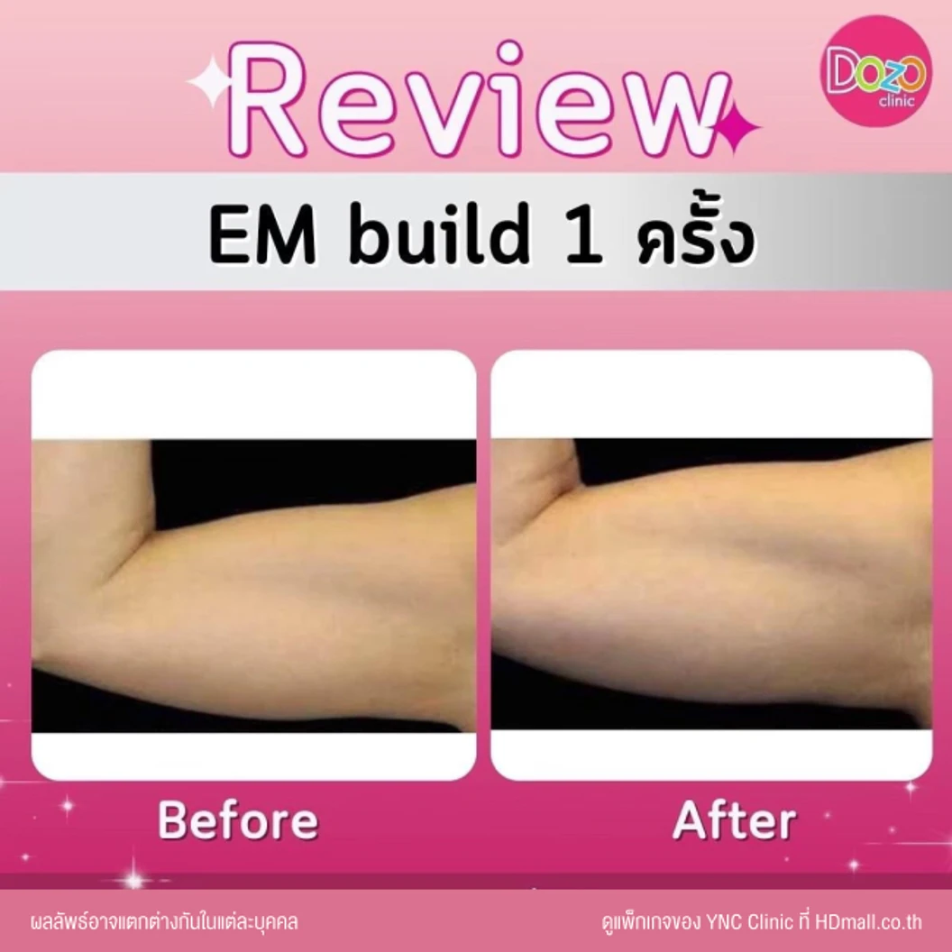 กระชับสัดส่วนสร้างกล้ามเนื้อ ด้วยเครื่อง EM Build เลือก 1 บริเวณ หน้าท้อง ก้น แขน หรือขา 1 ครั้ง