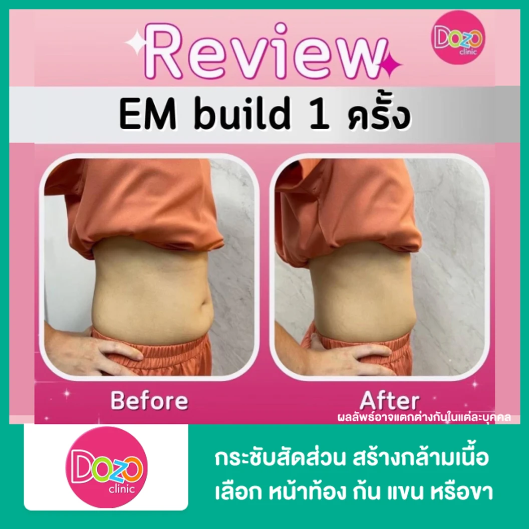กระชับสัดส่วนสร้างกล้ามเนื้อ ด้วยเครื่อง EM Build เลือก 1 บริเวณ หน้าท้อง ก้น แขน หรือขา 1 ครั้ง