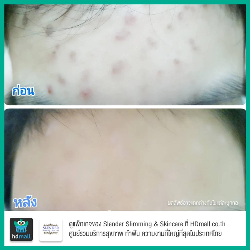 เลเซอร์ Q-Switch Nd: YAG Laser ปรับสภาพผิวให้ดูกระจ่างใส ลดรอยฝ้า กระ จุดด่างดำ บริเวณใบหน้า ครั้งละ 100 ช็อต 3 ครั้ง ที่ Slender Slimming & Skincare