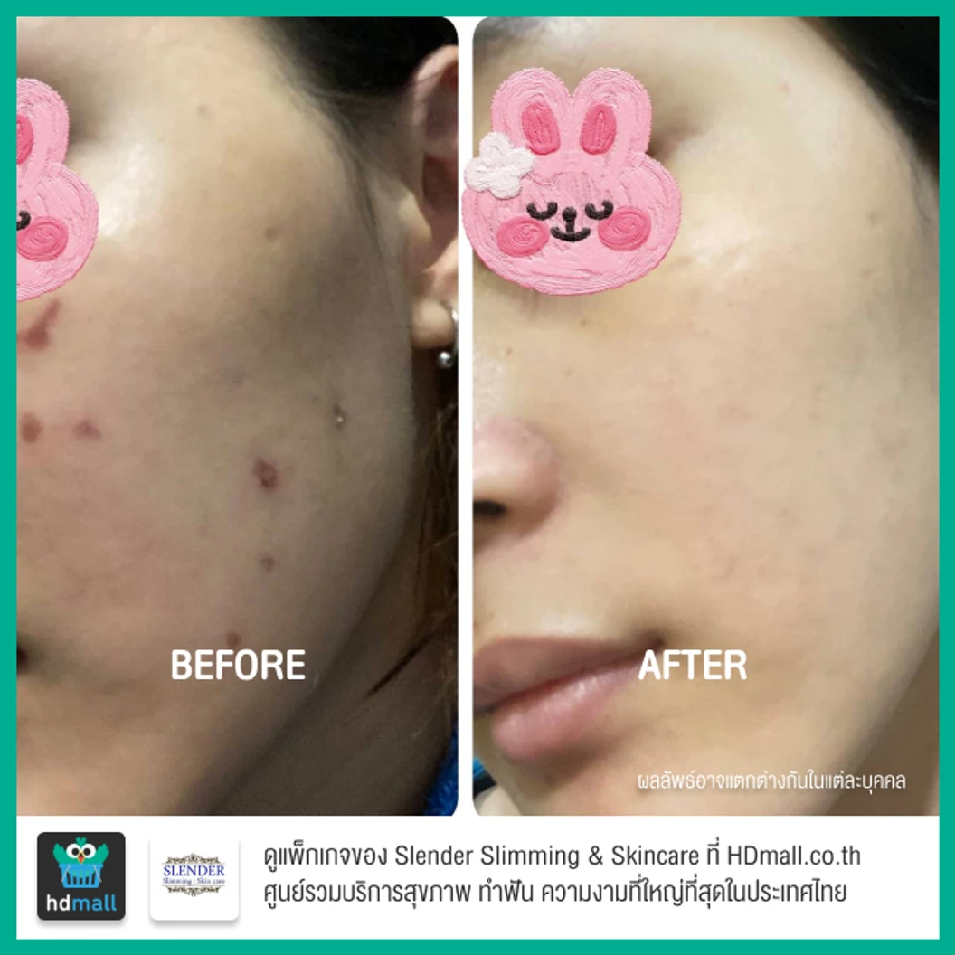 เลเซอร์ Q-Switch Nd: YAG Laser ปรับสภาพผิวให้ดูกระจ่างใส ลดรอยฝ้า กระ จุดด่างดำ บริเวณใบหน้า ครั้งละ 100 ช็อต 3 ครั้ง ที่ Slender Slimming & Skincare