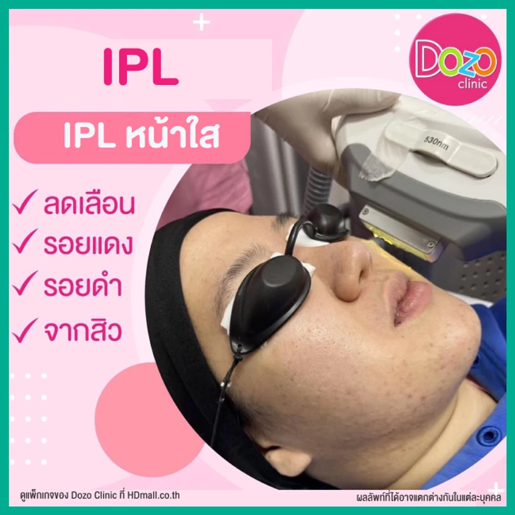 Acne Treatment รักษาสิว บริเวณใบหน้า 5 ขั้นตอน 1 ครั้ง