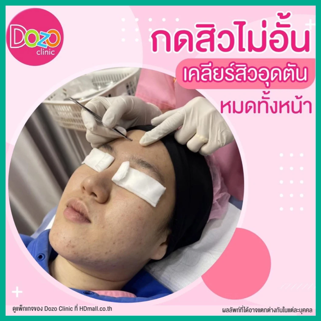 Acne Treatment รักษาสิว บริเวณใบหน้า 5 ขั้นตอน 1 ครั้ง