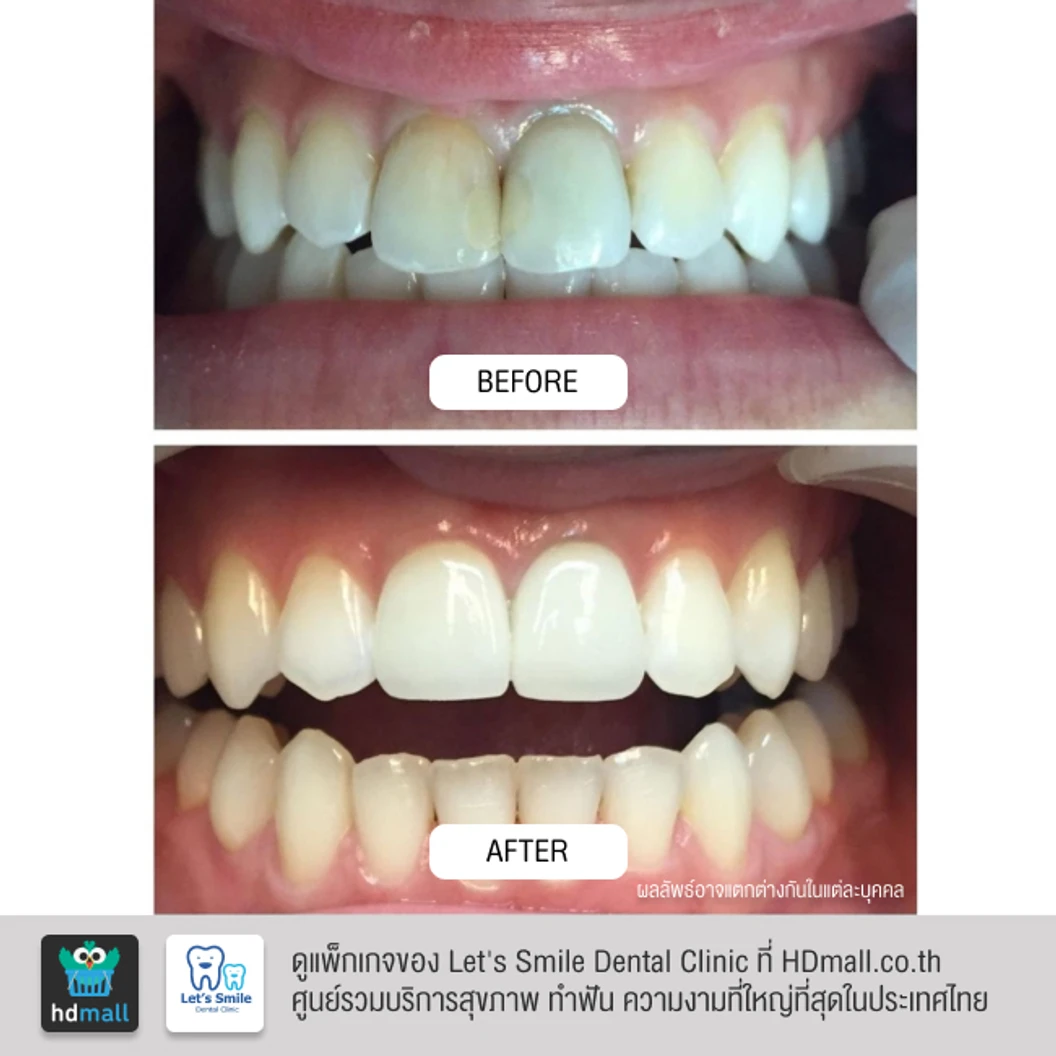 เคลือบผิวฟันและแปะฟันขาว ด้วยวีเนียร์เซรามิกหรือพอร์ซเลน 1 ซี่
