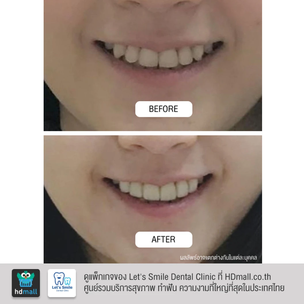 เคลือบผิวฟันและแปะฟันขาว ด้วยวีเนียร์เซรามิกหรือพอร์ซเลน 1 ซี่